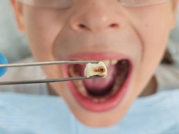 Best Root Canal Emergency Dentist  in Columbus Af, MS